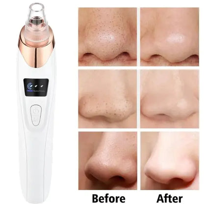 Blackhead Extractor